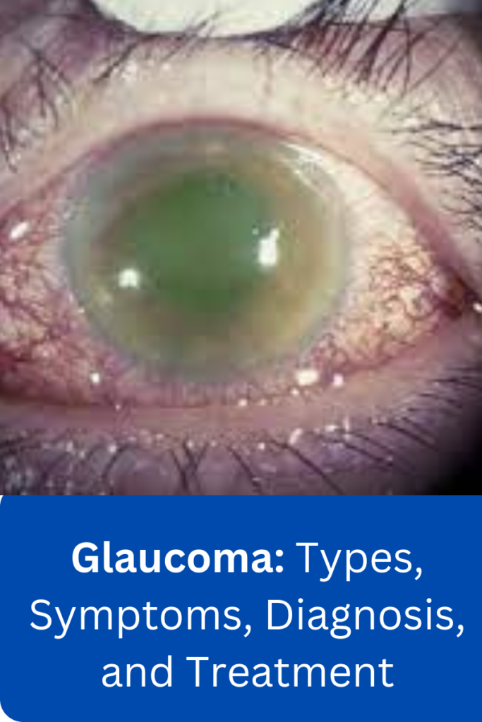 Glaucoma: Types, Symptoms, Diagnosis, and Treatment