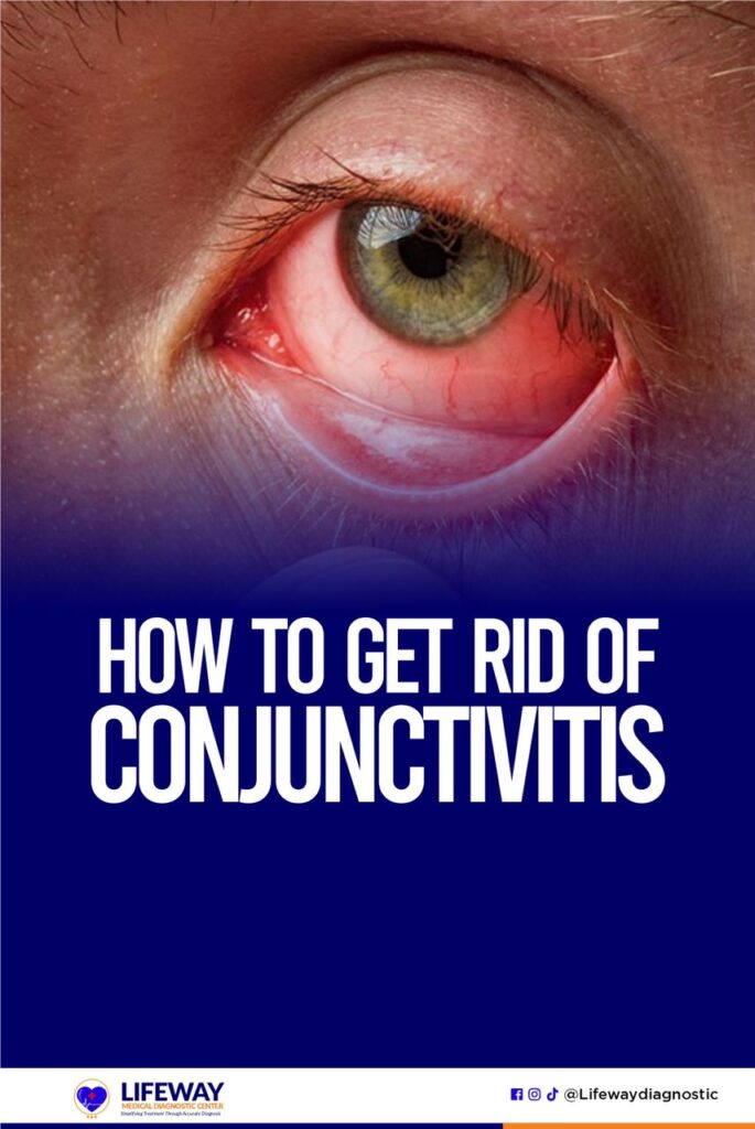 How To Get Rid Of Conjunctivitis