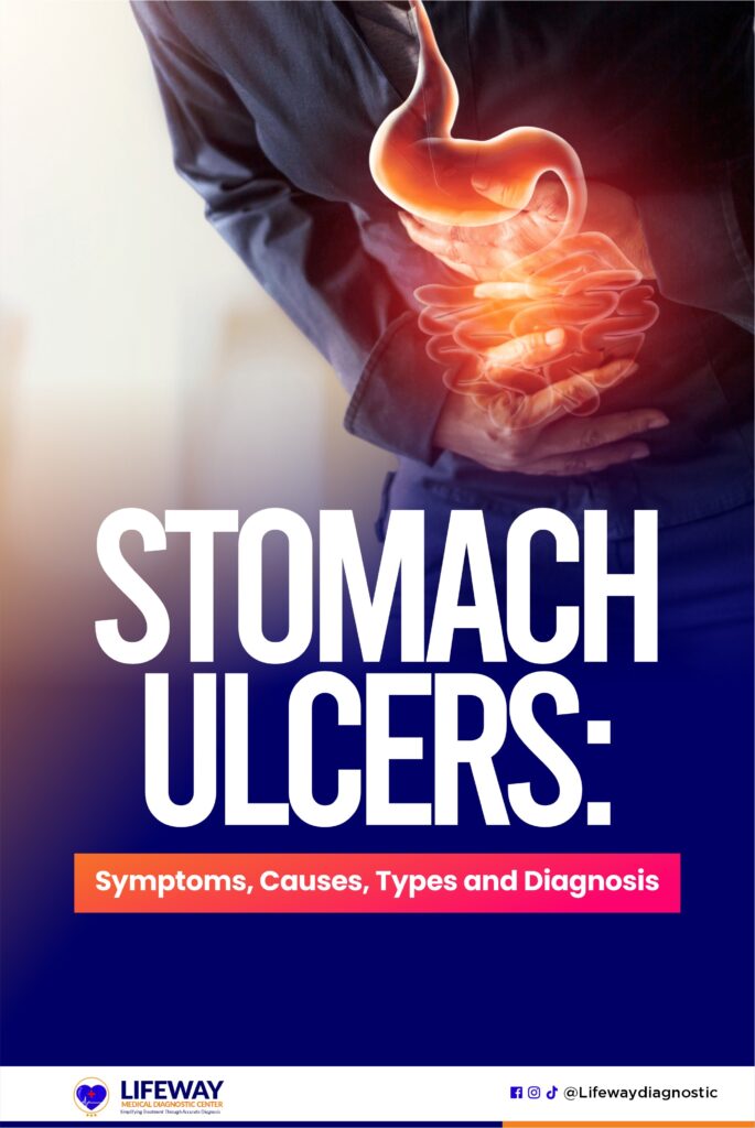 Stomach ulcers